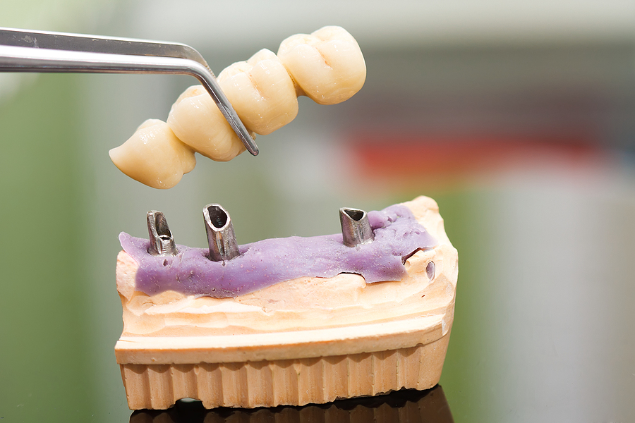 What Are Dental Implants?