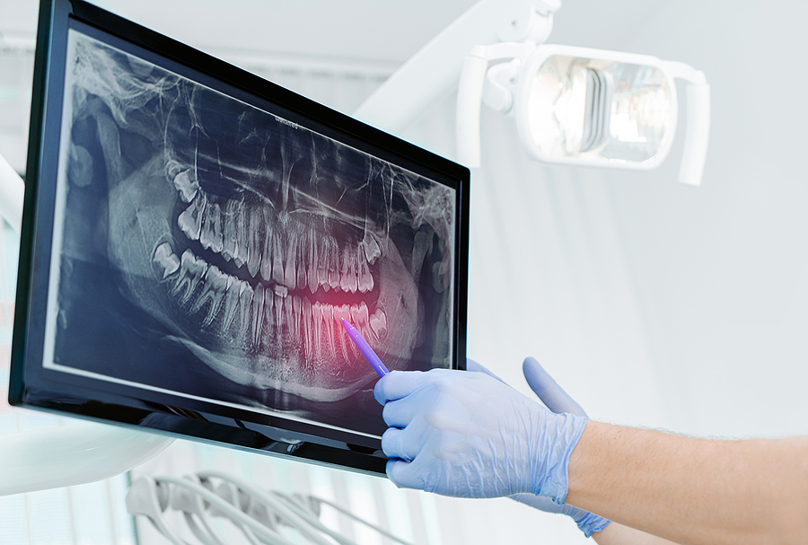 Advancing Dental Care with Digital X-Rays in Aurora, CO