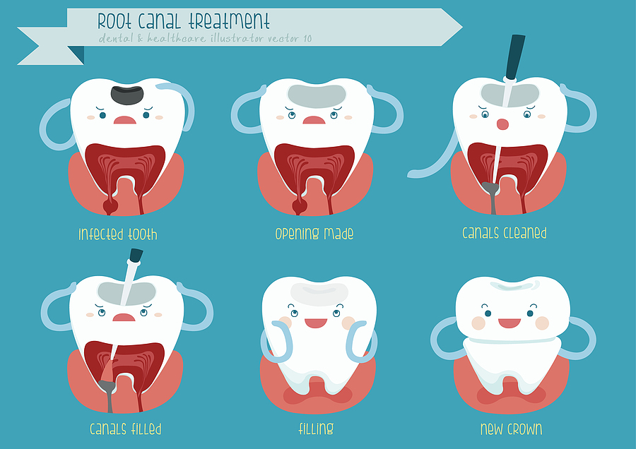 The Importance of Root Canal Therapy: Saving Your Natural Smile