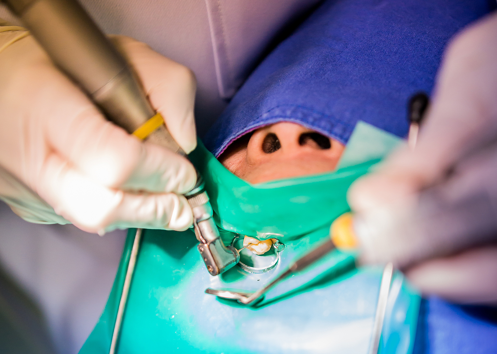Dental Crowns After Root Canal Therapy: Why They’re Often Needed 