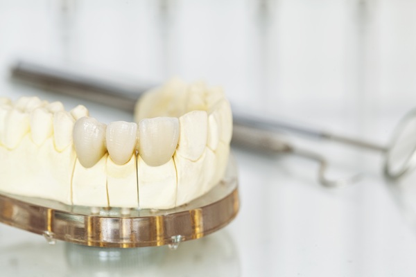 Dental Bridge Failure: What It Is And How To Avoid It