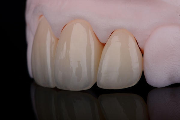 Signs It Is Time To Replace Or Refit Your Dental Crown