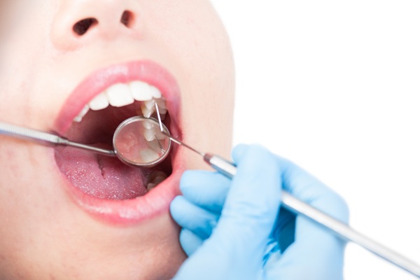 How Long Does A Dental Filling Last?