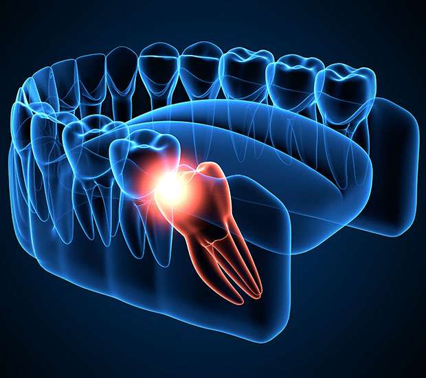 Aurora Wisdom Teeth Extraction